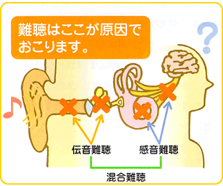 伝音難聴と感音難聴の両方が交じりあった難聴